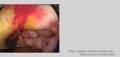 Double-balloon enteroscopy